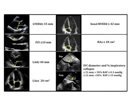 normal lv size echo|2d lv pw abnormal.